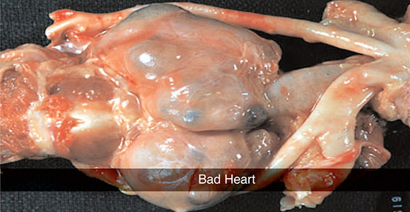 bad heart